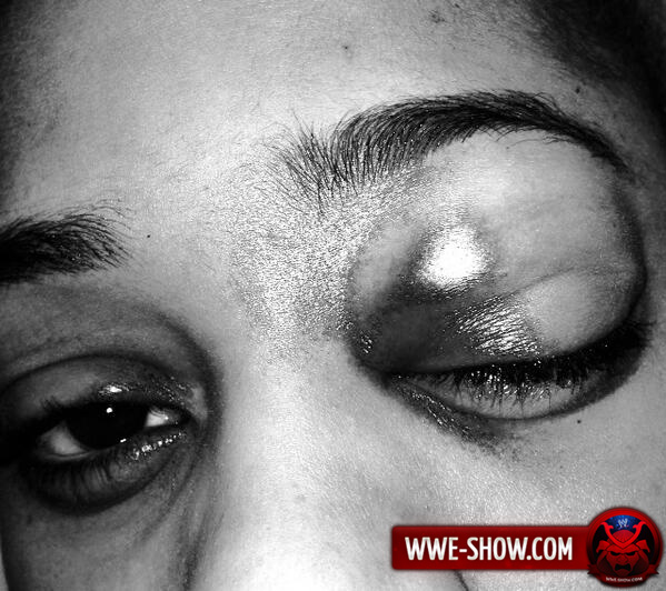 Наоми повредила глаз